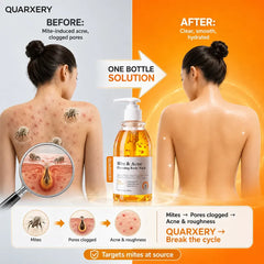Quarxery Mite & Acne Cleansing Body Wash – 250ml
