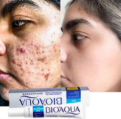 BIOAQUA Acne Removing & Rejuvenating Cream Combo