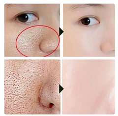 BIOAQUA Acne Removing & Rejuvenating Cream Combo