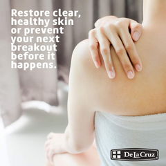 De La Cruz Maximum Strength Acne Treatment - 73.7g