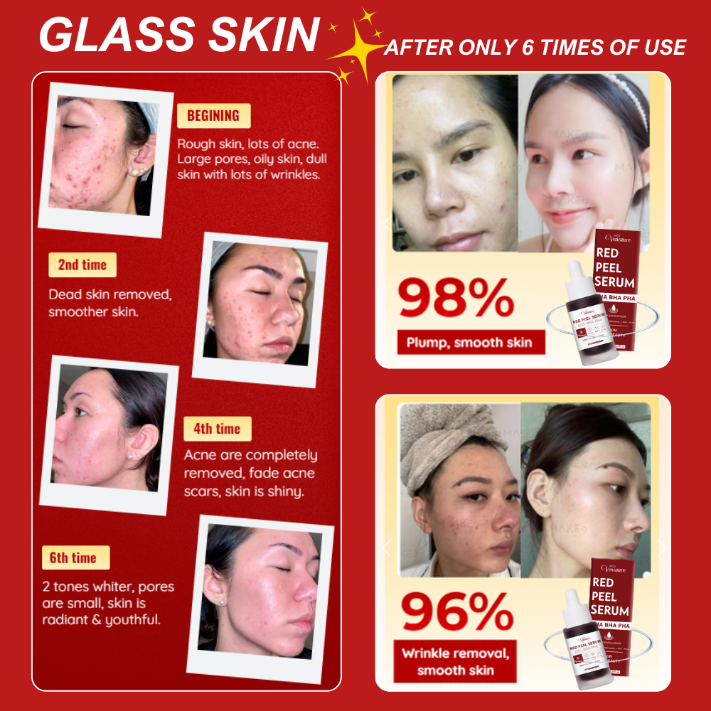 Venature Red Peel Serum - 20ml