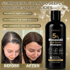 KORMESIC 5% Minoxidil with Biotin Shampoo – 300ml