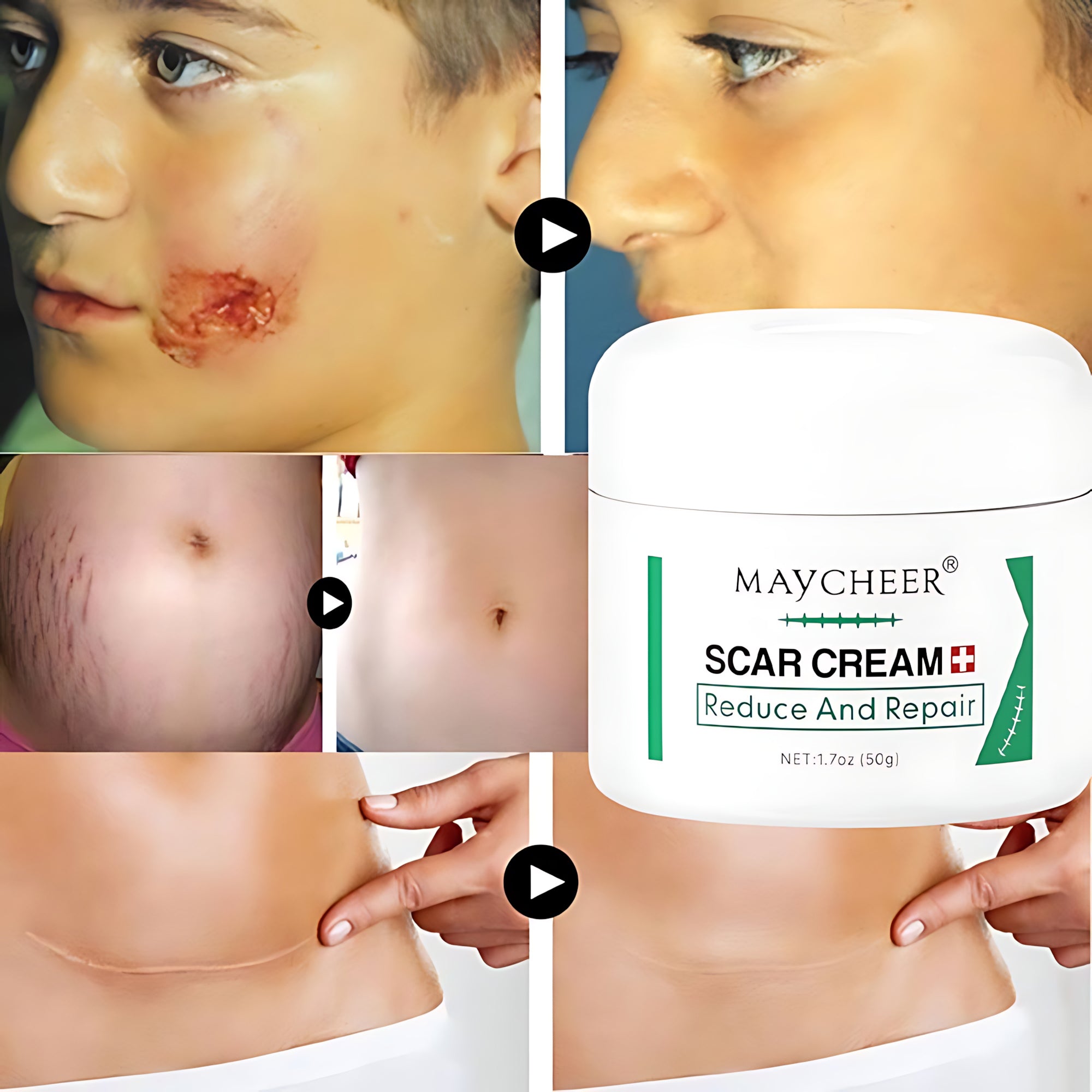 MAYCHEER Scar Cream – Advanced Scar Reduction & Skin Repair (50g)