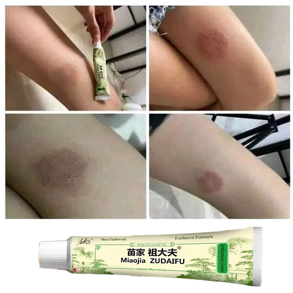 Miaojia Zudaifu Antibacterial Cream – Authentic Miao Formula (15g)